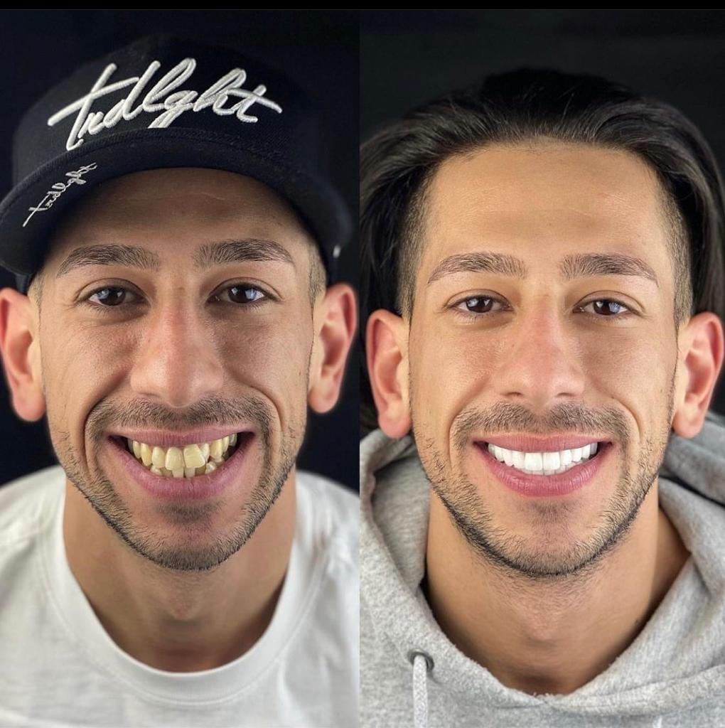 Çapraşık Dişler Hollywood Smile Öncesi Sonrası