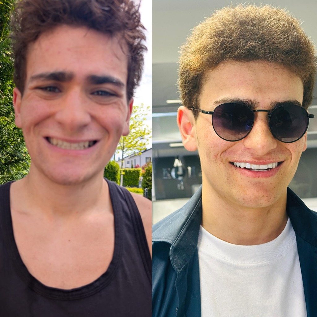 Lamine Veneers Avant Après